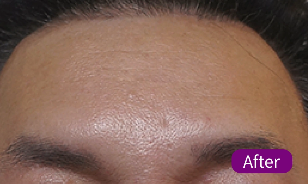 After BOTOX treatment-1
