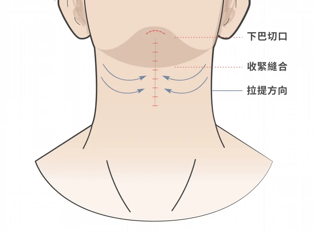 頸部拉皮手術部位示意圖