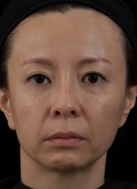 Full Face Neuramis Hyaluronic Acid Injection-Before Treatment