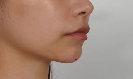 Chin Neuramis Hyaluronic Acid Injection-After