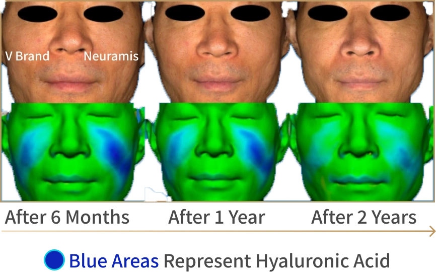 Comparison of duration between V brand and Neuramis, with a durability chart for six months, one year, and two years.