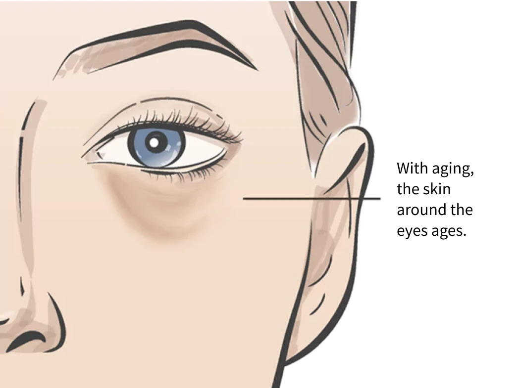 Aging Eye Bags Illustration