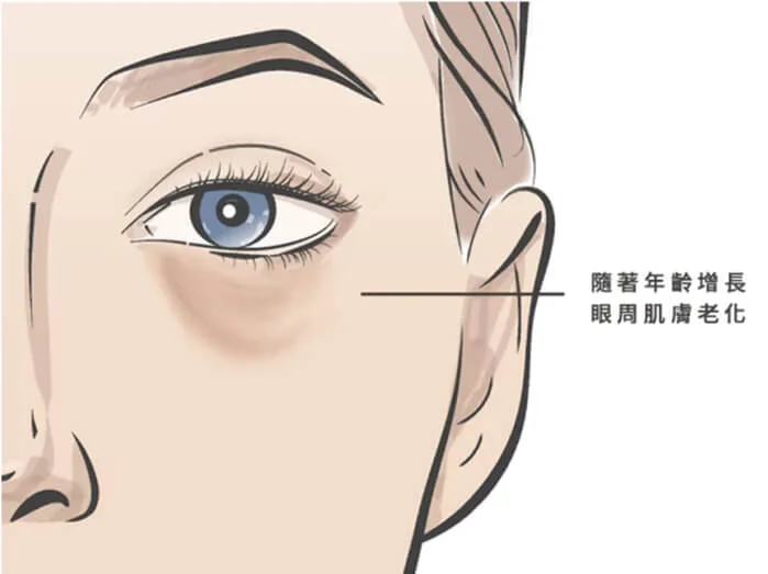 老化型眼袋示意圖
