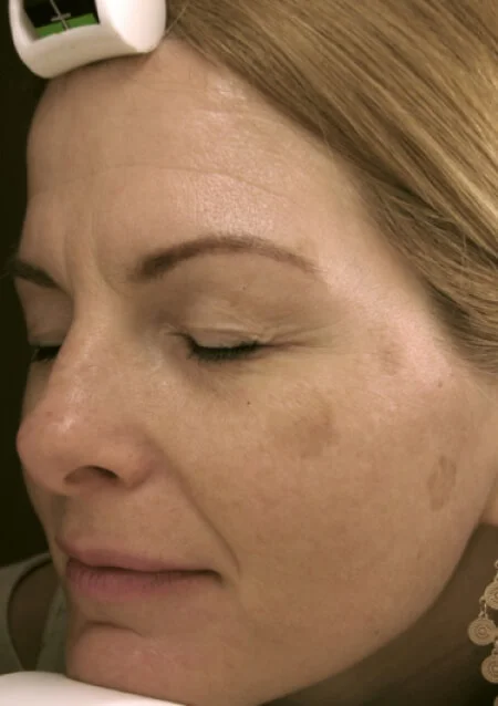 Face Pigmentation Clearing - Before Treatment
