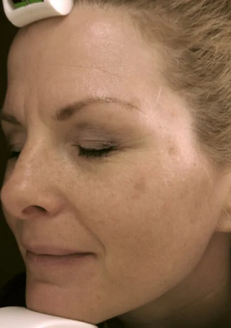 全臉除斑淨膚進度-1次治療