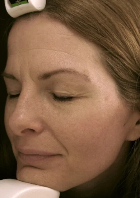 Face Pigmentation Clearing - After 3 Treatments