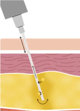 第三步-將乳化後呈液狀的脂肪經由專利VentX引流管吸出