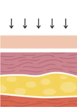 第四步-保留結締組織,促進皮膚收縮達到術後皮膚緊緻平滑