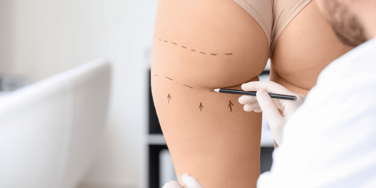 與傳統抽脂手術相比，威塑抽脂手術可以應用於多層次的脂肪雕塑技術，根據每個人的肌肉紋理進行層層雕塑。除了去除頑固脂肪細胞外，還能夠巧妙地控制淺層脂肪的比例，塑造出性感而流暢的迷人曲線。