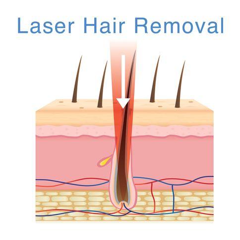雷射除毛是現今最流行的除毛方式，除毛機型也不斷推陳出新，而雷射除毛的原理是「黑色素會選擇性地對雷射光的吸收特別強」，主要是針對生長期的毛囊，因為此時的毛囊有很多黑色素，會吸收到高熱，進而破壞毛囊，達到抑制或延緩毛髮生長的效果。至於衰退期跟休止期的毛囊呢？由於此時的毛囊沒什麼黑色素，也不明顯，亦吸收不了什麼熱能，更沒有機會去破壞毛囊了。
