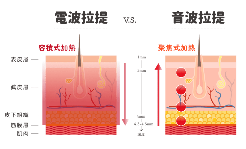所謂電波拉皮是利用高頻率的電子流動，在肌膚與脂肪組織間產生立體式加熱效果，進而刺激膠原蛋白的增生重組和組織收縮，達到緊緻肌膚、撫平褶皺的效果。