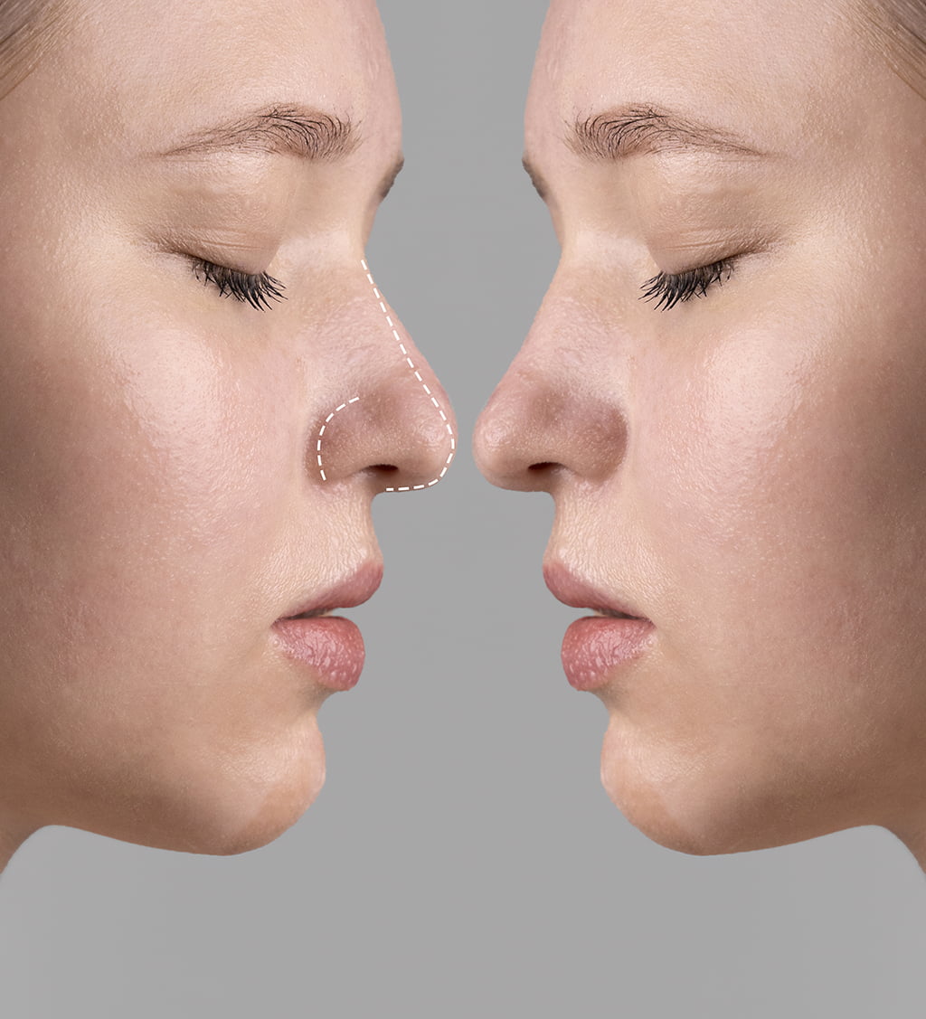 蒜頭鼻改善方法—微整類