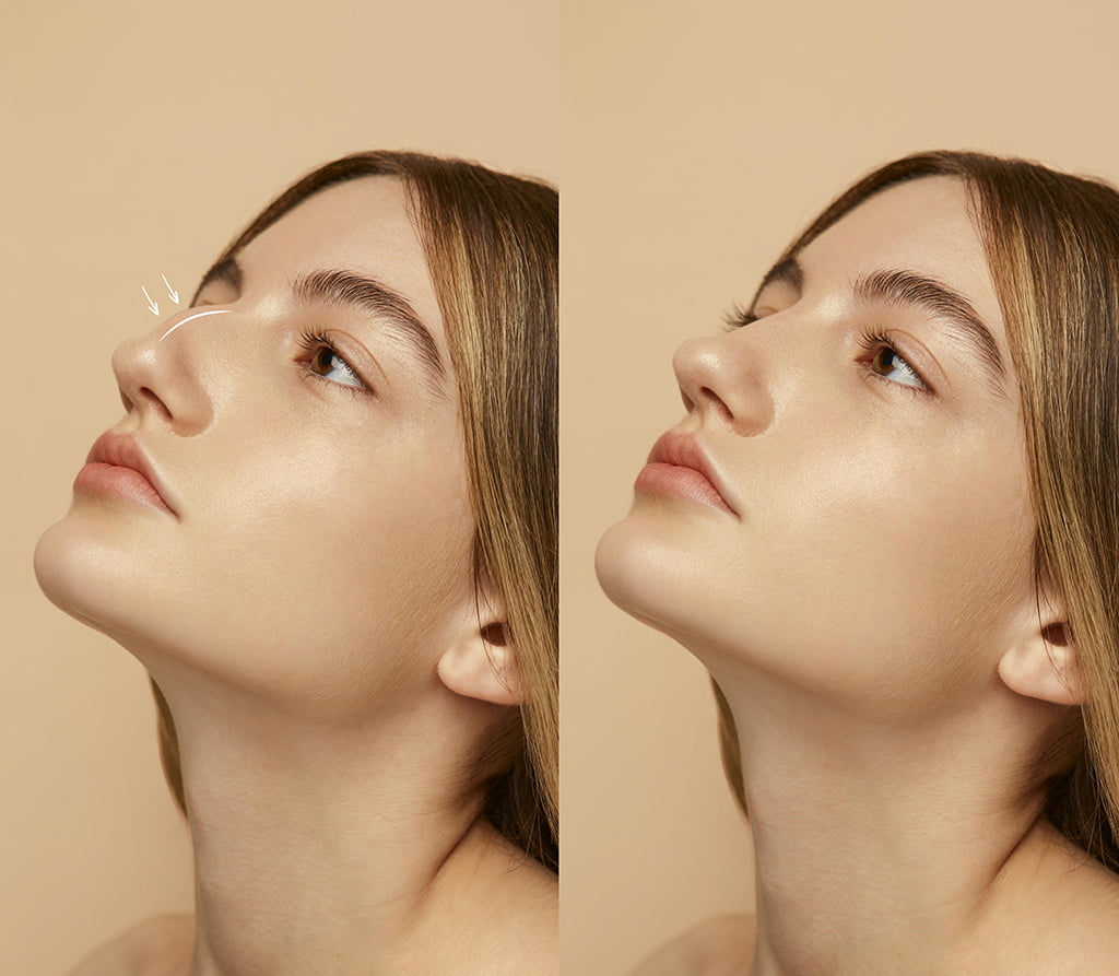 蒜頭鼻改善方法—手術類